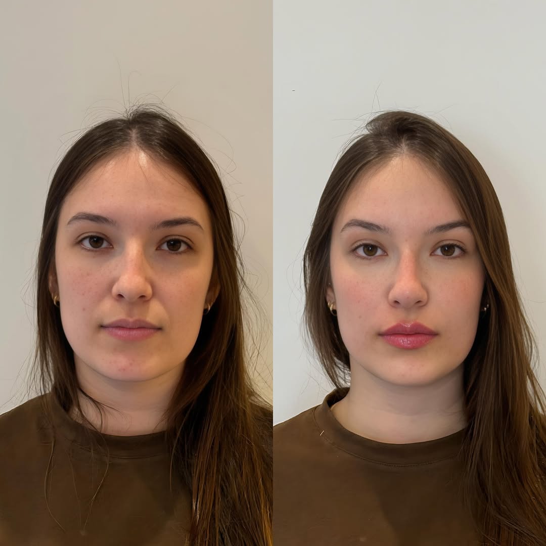 Resultado tratamento 2