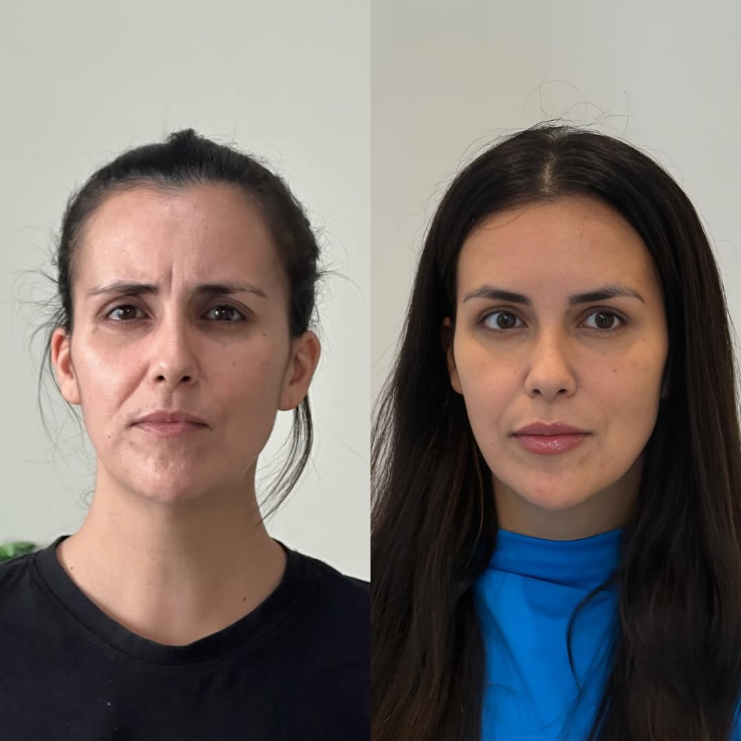 Resultado BOTOX